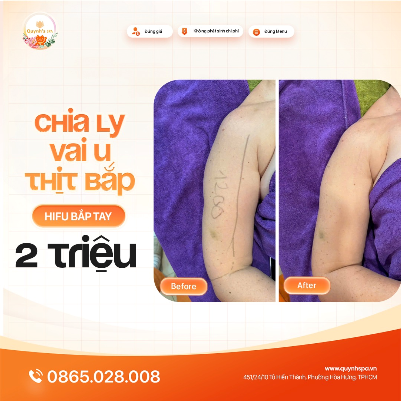 Chia ly “vai u thịt bắp” theo cách dễ dàng với Hifu bắp tay tại Quynh's Spa Q.10
