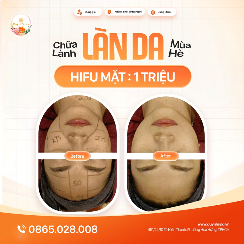 Chơi về ghé Quỳnh Spa chữa lành và nâng cấp làn da cùng Hifu tại QUynh's Spa P. Diên Hồng