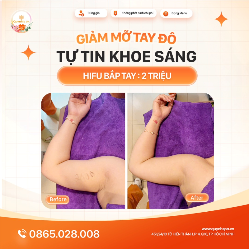 Đừng để bắp tay mỡ - Làm lu mờ khoảnh khắc tỏa sáng của nàng hifu bắp tay Quynh's Spa Diên Hồng