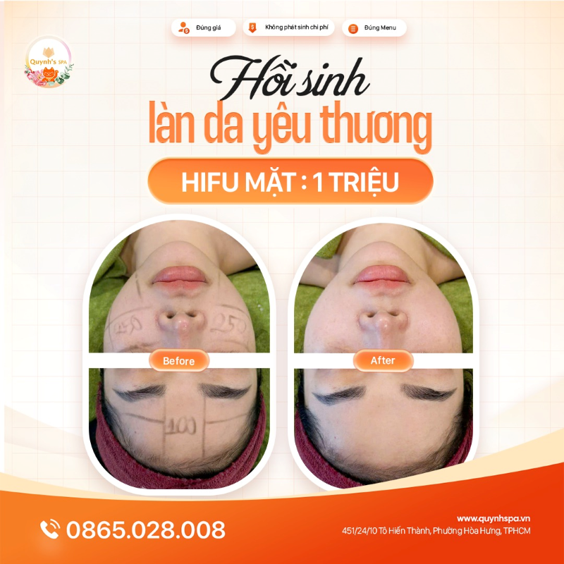 Hồi sinh da đầy yêu thương cùng Công nghệ Hifu tại Quynh's Spa P. Diên Hồng