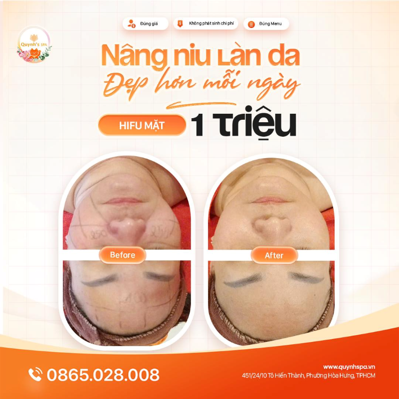 Làn da không biết nói, nhưng sẽ “kể tội” nàng Hifu mặt tại Quynh's Spa Q.10