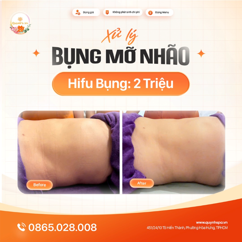 Muốn bụng hết mỡ nhão, tìm lại lại vòng eo săn chắc tự nhiên cùng Hifu bụng