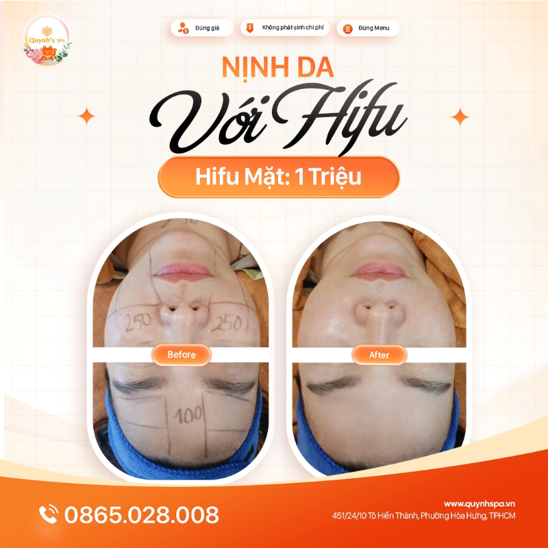 “Nịnh da” quá dễ với Hifu Nhà Quỳnh phường Diên Hồng TP.HCM