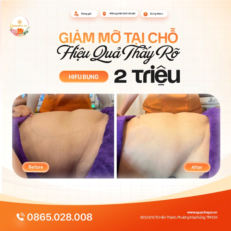 Giảm mỡ tại chỗ - Hiệu quả thấy rõ với Hifu bụng tại Quynh's Spa P. Diên Hồng
