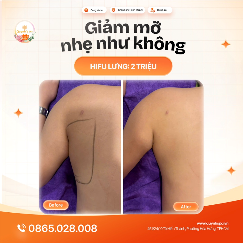 Nói không với mỡ lưng tự ti với hifu lưng tại Quynh's Spa Q.10