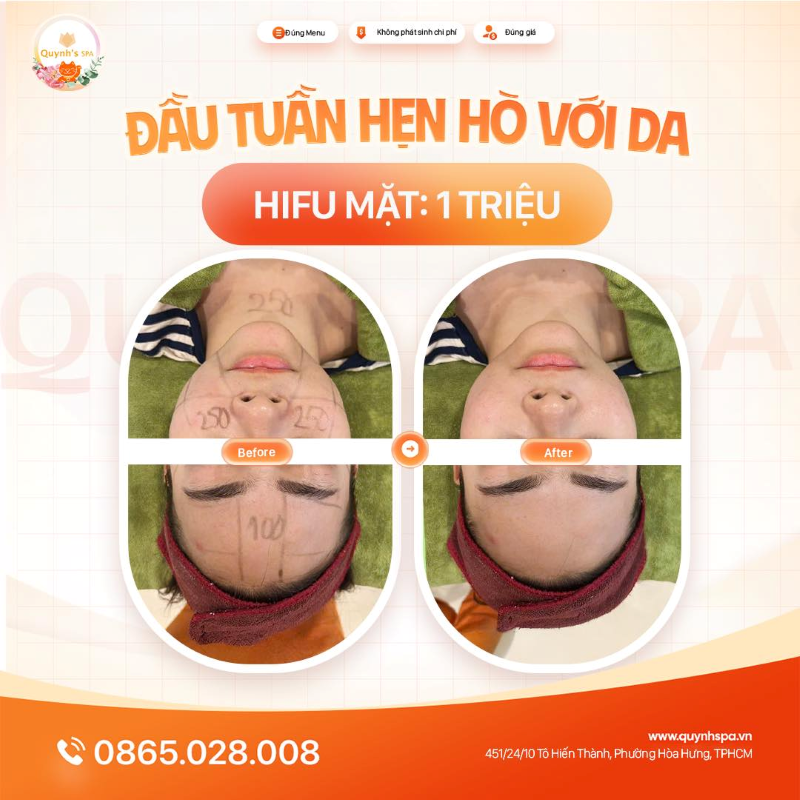 Chân ái đầu tuần : nạp năng lượng cho da với Hifu Mặt tại Quynh's Spa Q.10