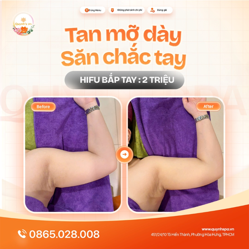 Chẳng cần che giấu, Hifu có thể xử lý cả mỡ bắp tay dày cỡ này cơ mà