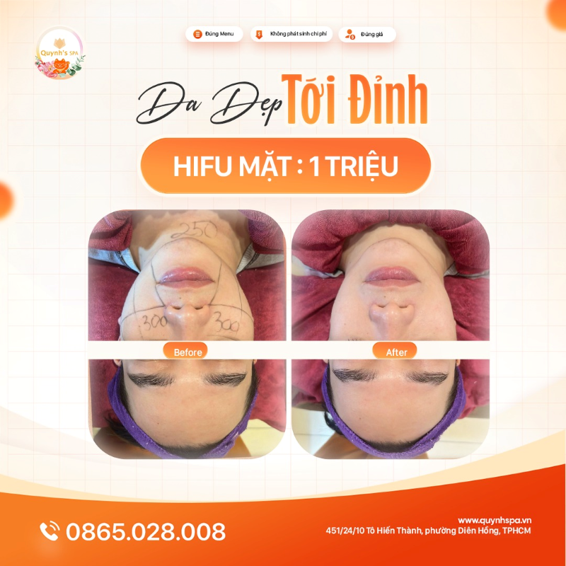 Da nàng xứng đáng đẹp tới đỉnh với hifu mặt tại Quynh's Spa Quận 10