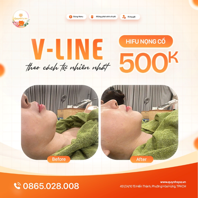 Góc mặt V-Line theo cách tự nhiên nhất với Hifu V-line tại Quynh's Spa Q.10