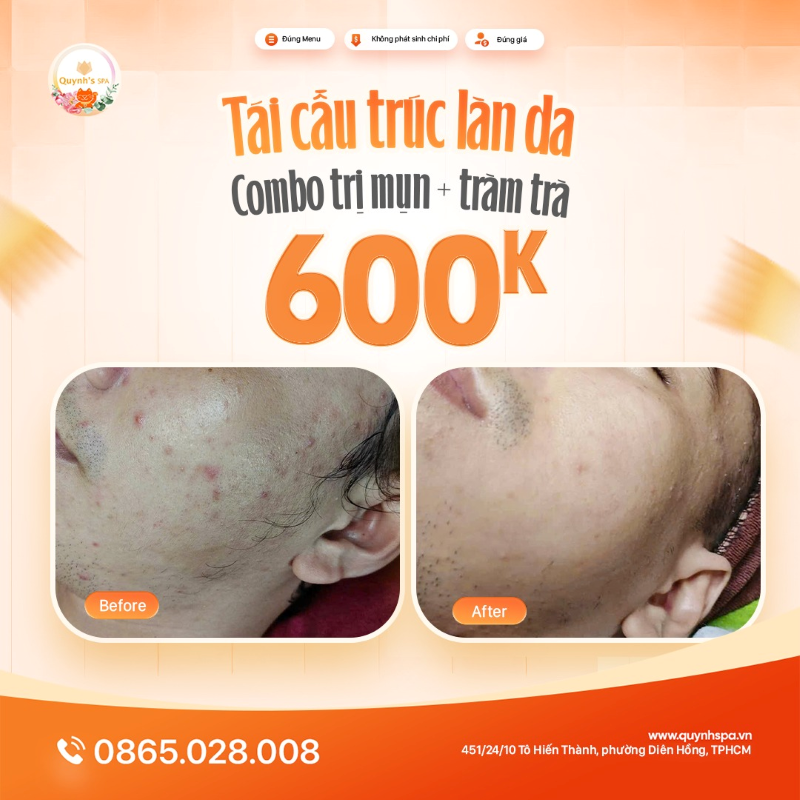 Hành trình dẹp mụn - Tái cấu trúc làn da nam tại Quynh's Spa Quận 10