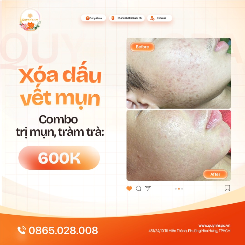 Không còn dấu vết của mụn, chỉ còn sự tự tin tại Quynh's Spa Q.10