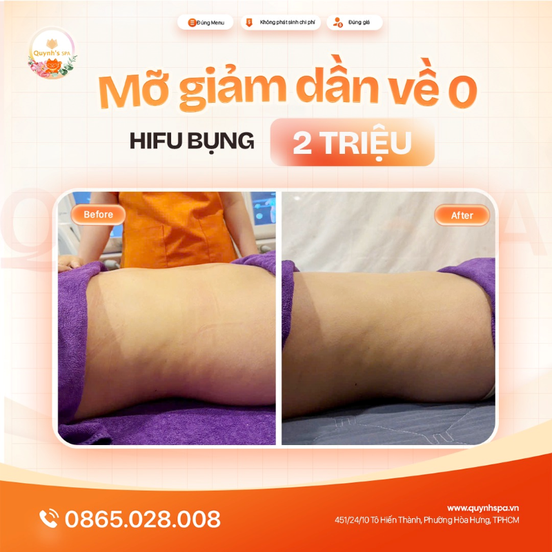 Mỡ giảm dần về 0 cùng Hifu bụng tại Quynh's Spa P. Diên Hồng