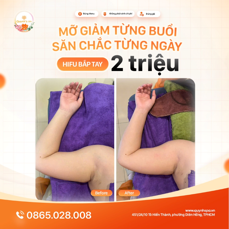 Mỡ giảm từng buổi - Săn chắc từng ngày với Hifu bắp tay tại Quynh's Spa Q.10