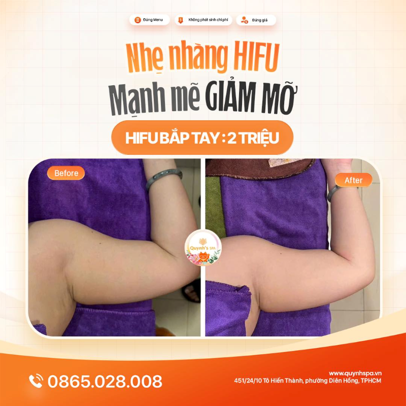 Nhẹ nhàng HIFU - Mạnh mẽ GIẢM MỠ bắp tay tại Quynh's Spa phường Diên Hồng