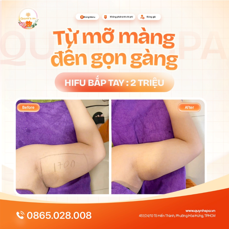 Từ mỡ màng, đến ngỡ ngàng vì gọn gàng quá đỗi với Hifu bắp tay tại Quynh's Spa Q.10