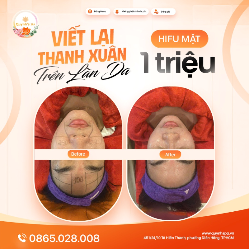 Cứ để Hifu viết lại thanh xuân trên gương mặt bạn tại Quynh's Spa Q10