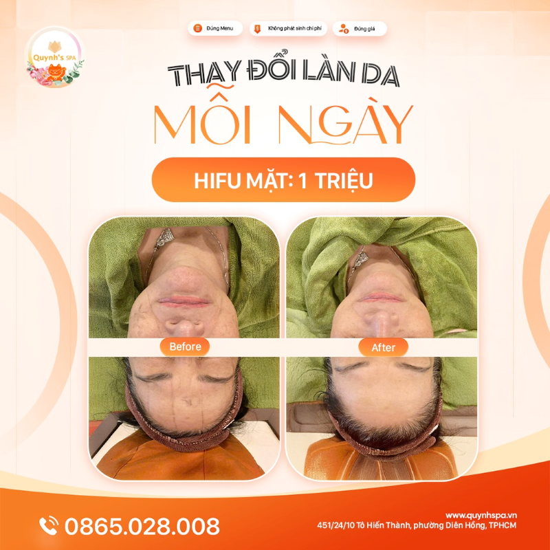 Mỗi tấm hình là một câu chuyện thay đổi – Và tất cả đều bắt đầu từ liệu trình Hifu!