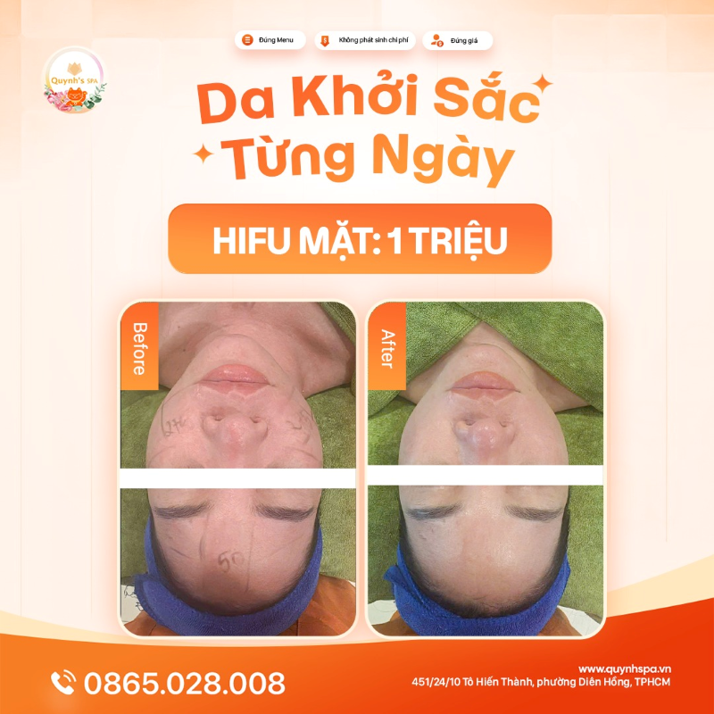 Hành trình da khởi sắc từng ngày với Hifu mặt tại Quynh's Spa Q10