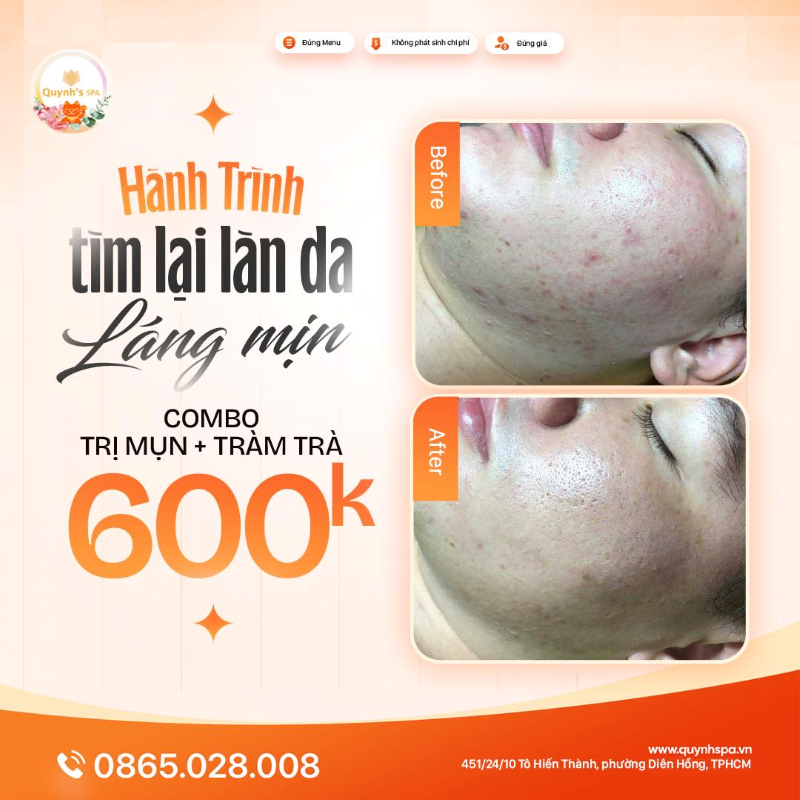 Hành trình tìm lại làn da láng mịn tại Quynh's Spa quận 10