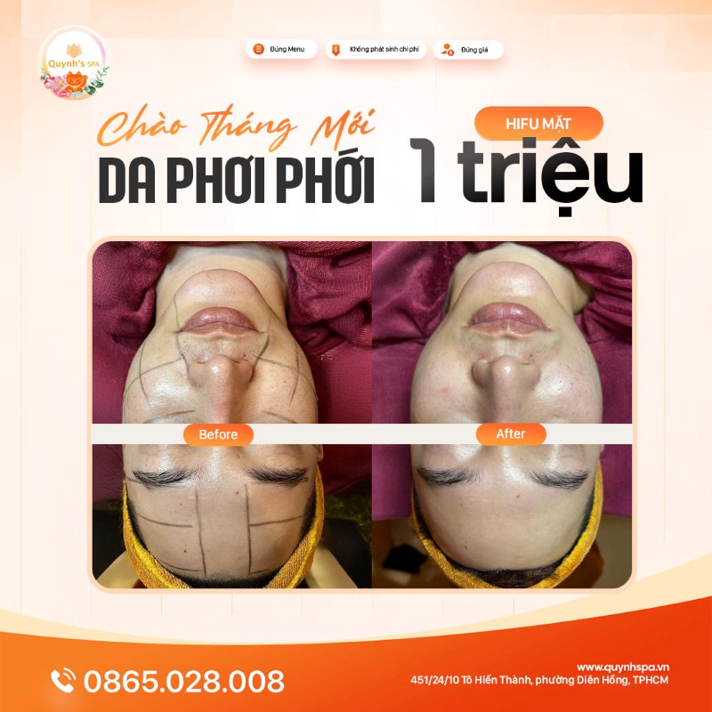 Khởi đầu tháng mới với làn da phơi phới với Hifu mặt