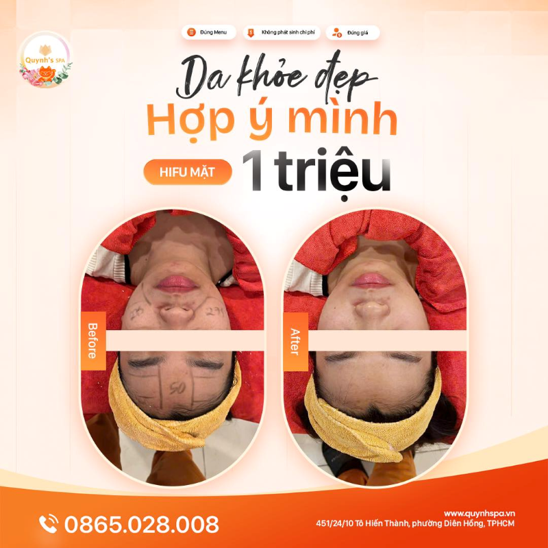 Nuôi dưỡng làn da khỏe đẹp của chính mình với Hifu mặt tại Quynh's Spa