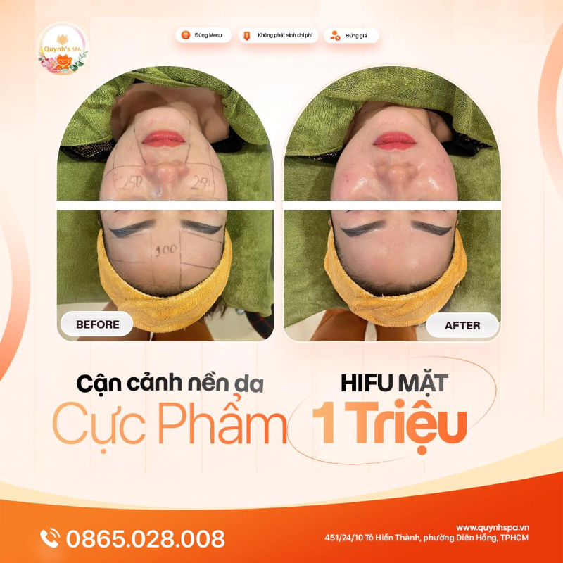Cận cảnh nền da cực phẩm với hifu mặt tại Quynh's Spa quận 10