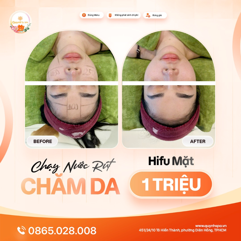 Chạy nước rút chăm da, kịp xinh đón 2026 với hifu mặt tại Quynh's Spa Q10