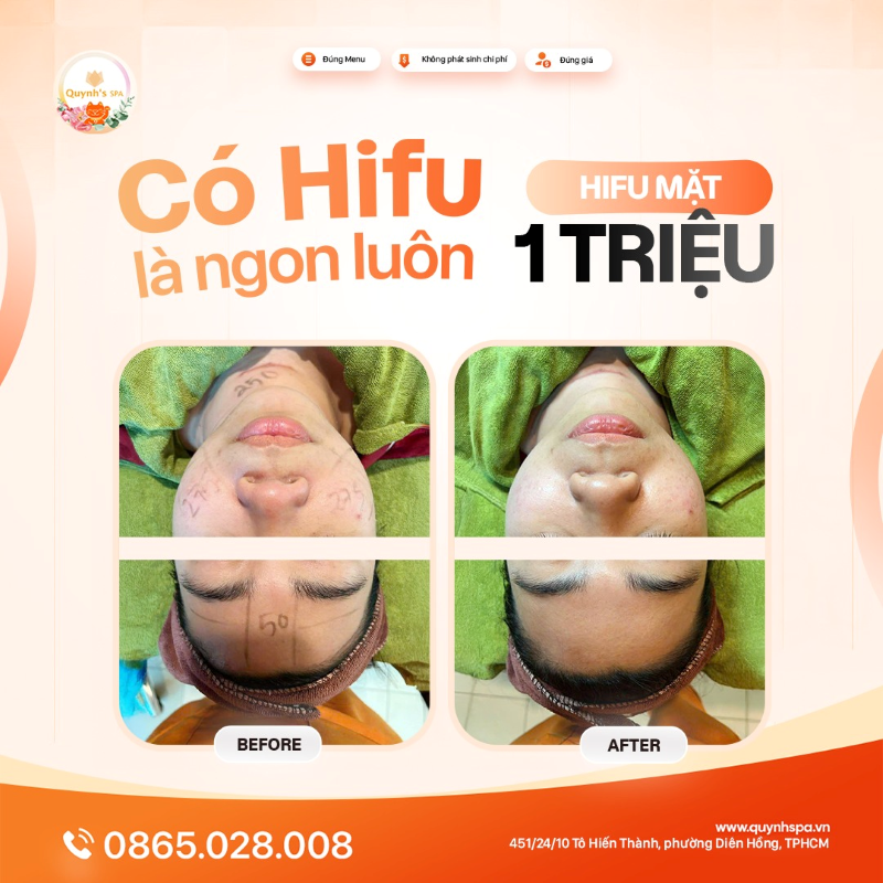 Da cải thiện thế này là ngon luôn với Hifu mặt tại Quynh's Spa Q10