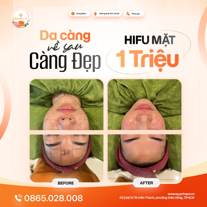 Nhà Quỳnh gây ấn tượng bằng kết quả làn da thực tế với Hifu mặt