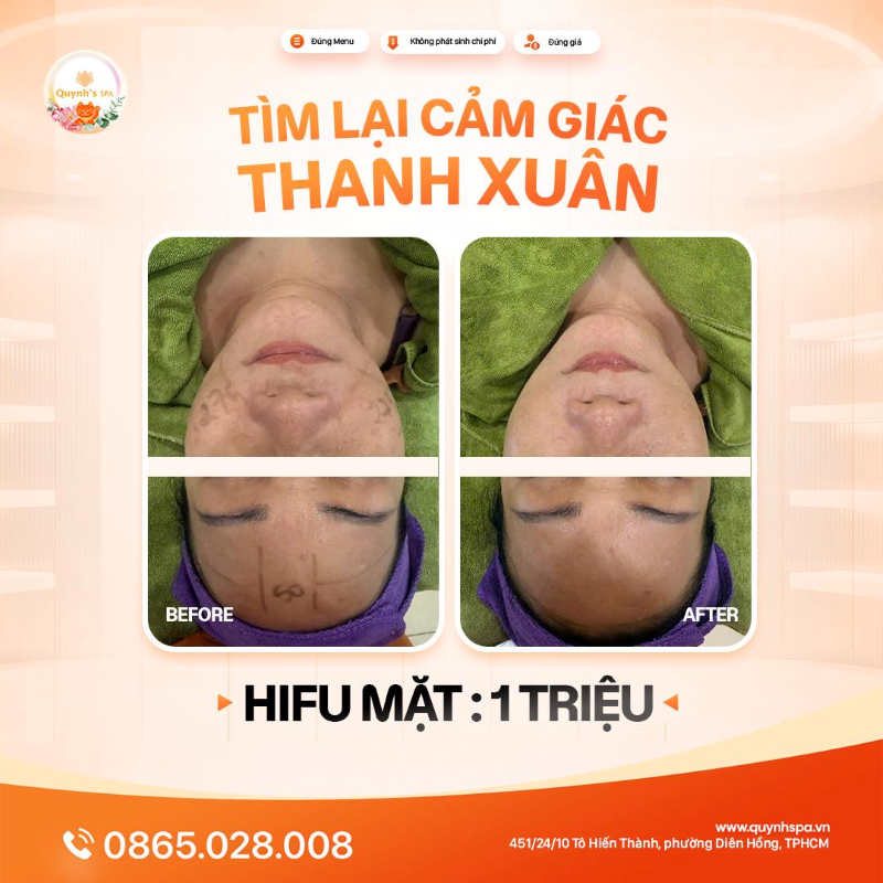 Thanh xuân là cảm giác làn da - Hifu giúp nàng tìm lại tại Quynh's Spa Q.10