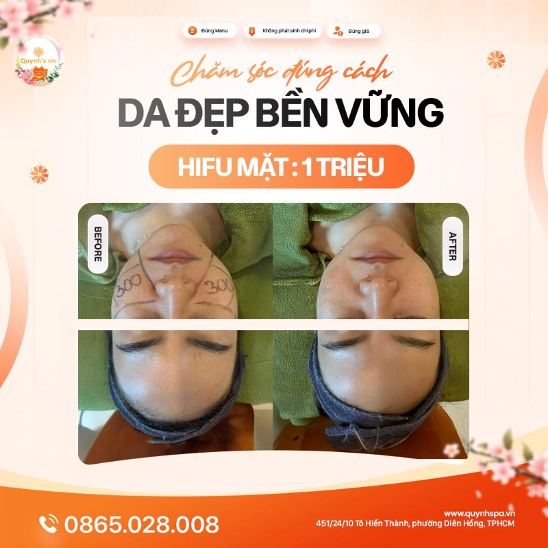 Chăm da đúng cách - Da đẹp bền vững với Hifu mặt tại Quynh's Spa Q10