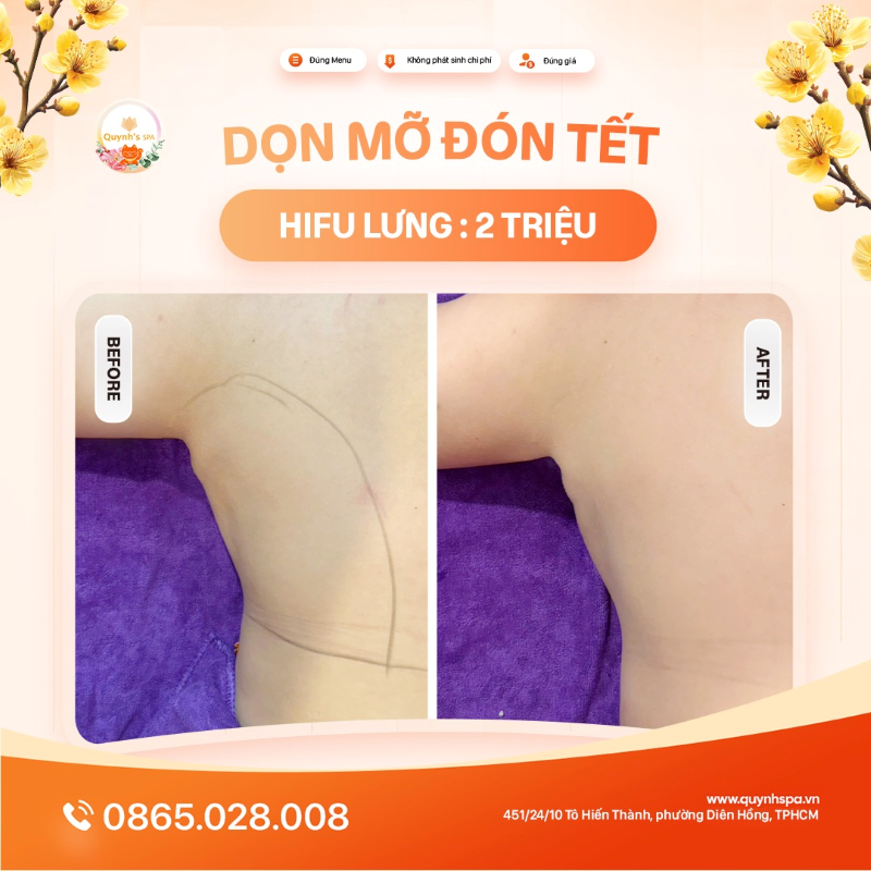 Dọn mỡ đón Tết với Hifu Lưng tại Quynh' Spa Phường Diên Hồng