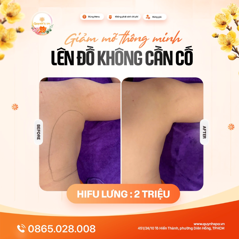 Giảm mỡ thông minh - Lên đồ không cần cố với Hifu lưng tại Quynh' Spa Q.10