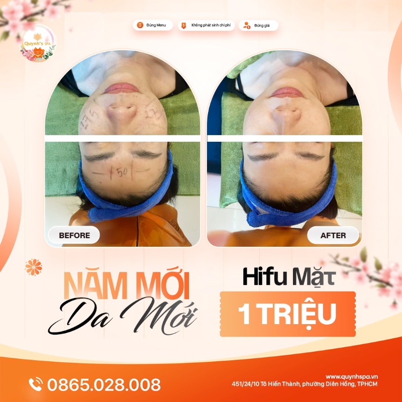 Năm mới, chào da mới với Hifu mặt tại Quynh's Spa quận 10