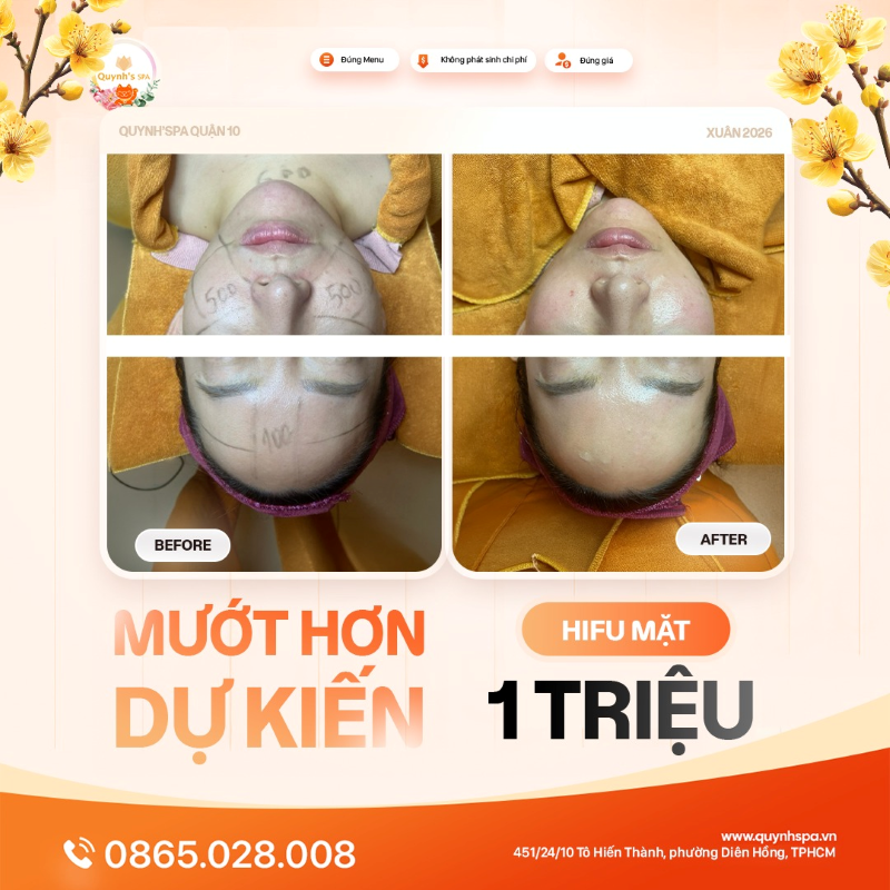 Da mướt hơn dự kiến với Hifu mặt tại Quynh' Spa quận 10