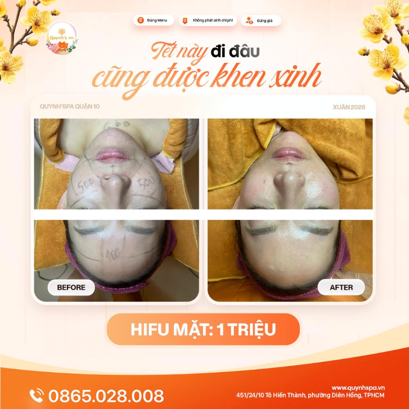 Tết này đi đâu cũng được khen da xinh với Hifu trẻ hóa Quynh's Spa Q.10