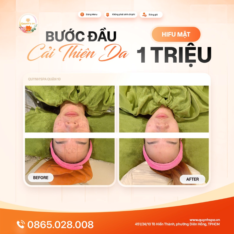 Bước đầu hành trình cải thiện da với Hifu mặt tại Quynh's Spa P. Diên Hồng