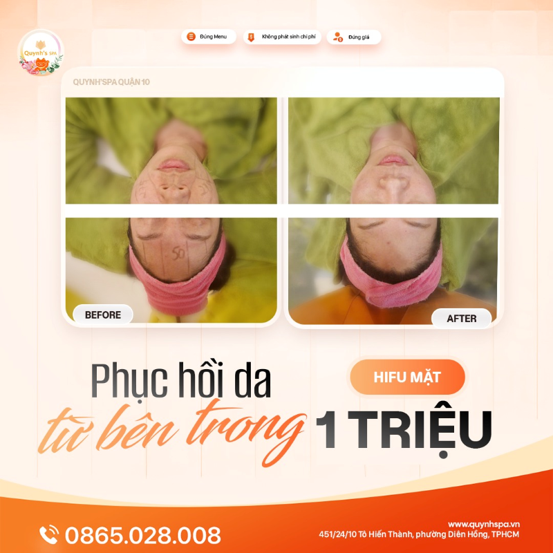 Phục hồi da từ sâu bên trong với Hifu mặt tại Quynh's Spa quận 10