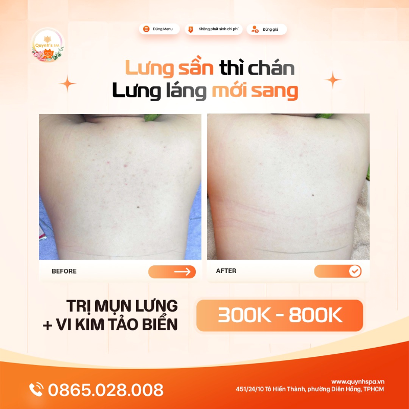 Lưng sần thì chán - Phải lưng láng mới sang trị mụn lưng Quynh's Spa Q.10