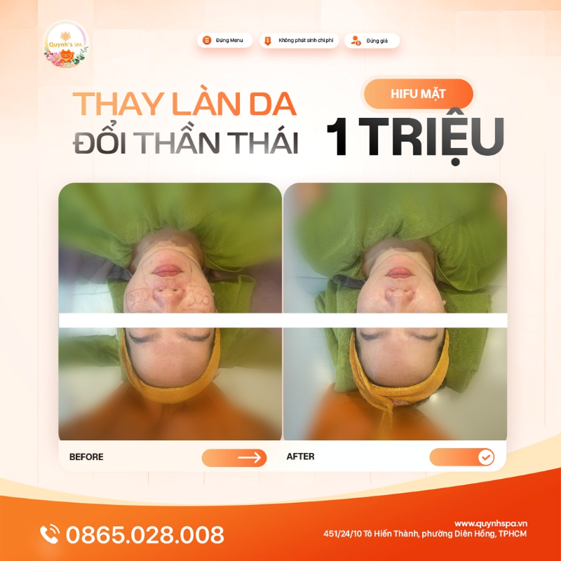 Thay làn da - Đổi thần thái với Hifu mặt tại Quynh's Spa P. Diên Hồng
