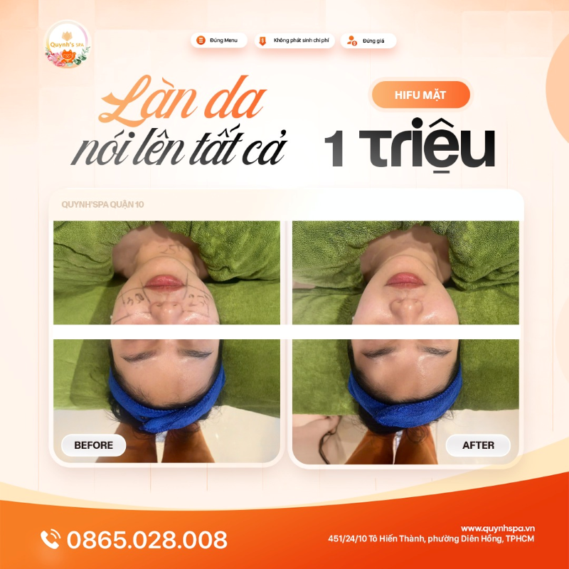 Vì làn da không thể nói dối - Hifu mặt Quynh's Spa quận 10
