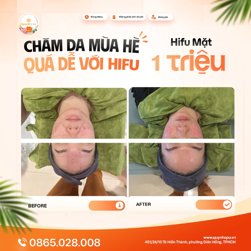 Chăm da mùa hè quá dễ với Hifu với Hifu mặt tại QUynh' Spa P. Diên Hồng