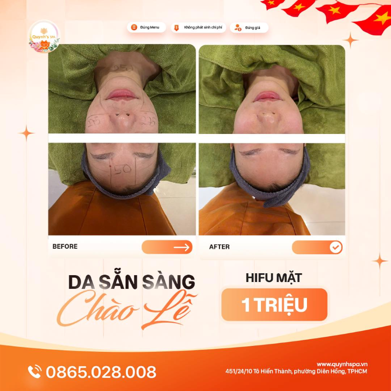 Da sẵn sàng chào Lễ với Hifu mặt tại Quynh' Spa phường Diên Hồng