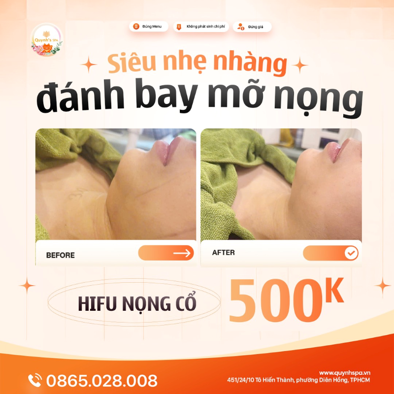 Đánh bay mỡ nọng mà chẳng lo sưng bầm Hifu nọng cổ Quynh's Spa Q.10