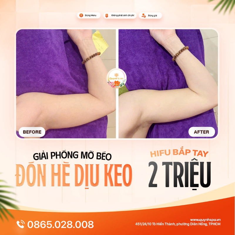 Giải Phóng Mỡ Béo - Chào Hè Dịu Keo với Hifu bắp tay tại Quynh' Spa