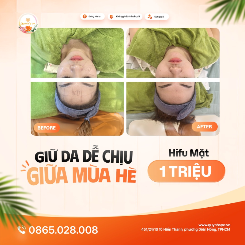 Giữ da dễ chịu giữa trời hè oi bức với Hifu mặt tại Quynh' Spa quận 10