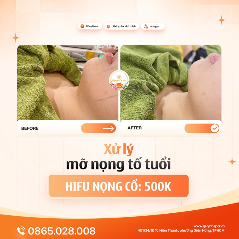 Mỡ nọng cổ mới là kẻ tố cáo “lão hóa” rõ nhất - Quynh's Spa Q.10