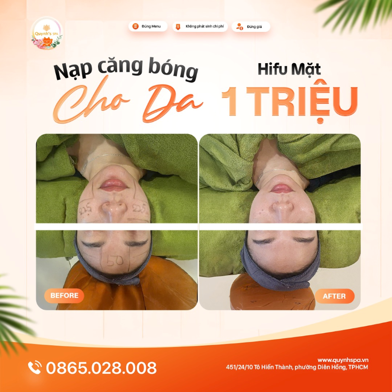 Nạp căng bóng cho da với Hifu mặt