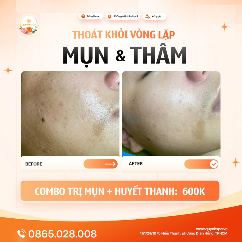Nếu bạn đang trong vòng lặp BÙNG MỤN - TÀN THÂM - TÁI MỤN