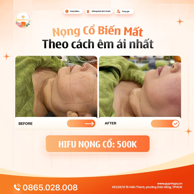 Mỡ nọng cổ biến mất theo cách “êm ái” nhất với hifu nọng cổ tại Quynh' Spa Q.10